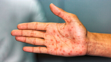 Die Syphilis geht um